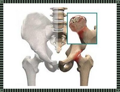 早期股骨头坏死的最佳治疗法：探索与前行