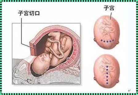 如何缓解剖腹产的恐惧心理