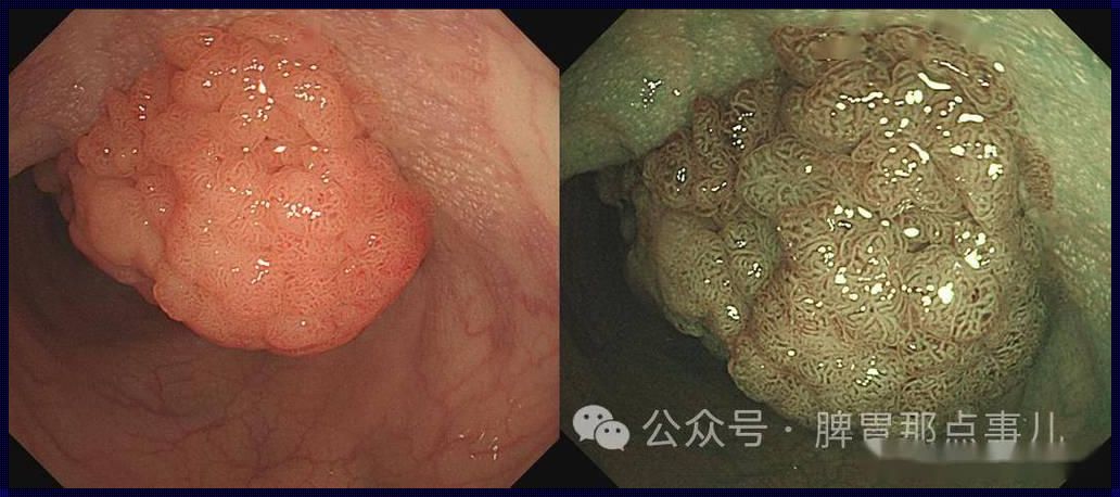 探索直肠粘液腺癌术后生命预期：希望与挑战并存