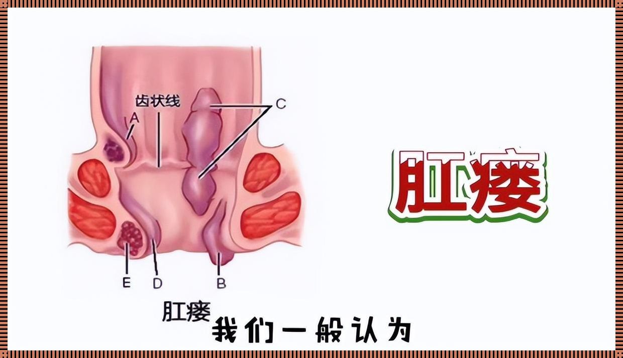 揭秘肛瘘必须手术的骗局：如何避免陷入医疗陷阱