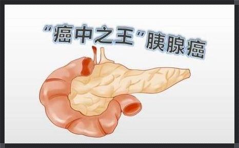 胰腺癌具有很强遗传性：揭示其遗传密码的深度剖析