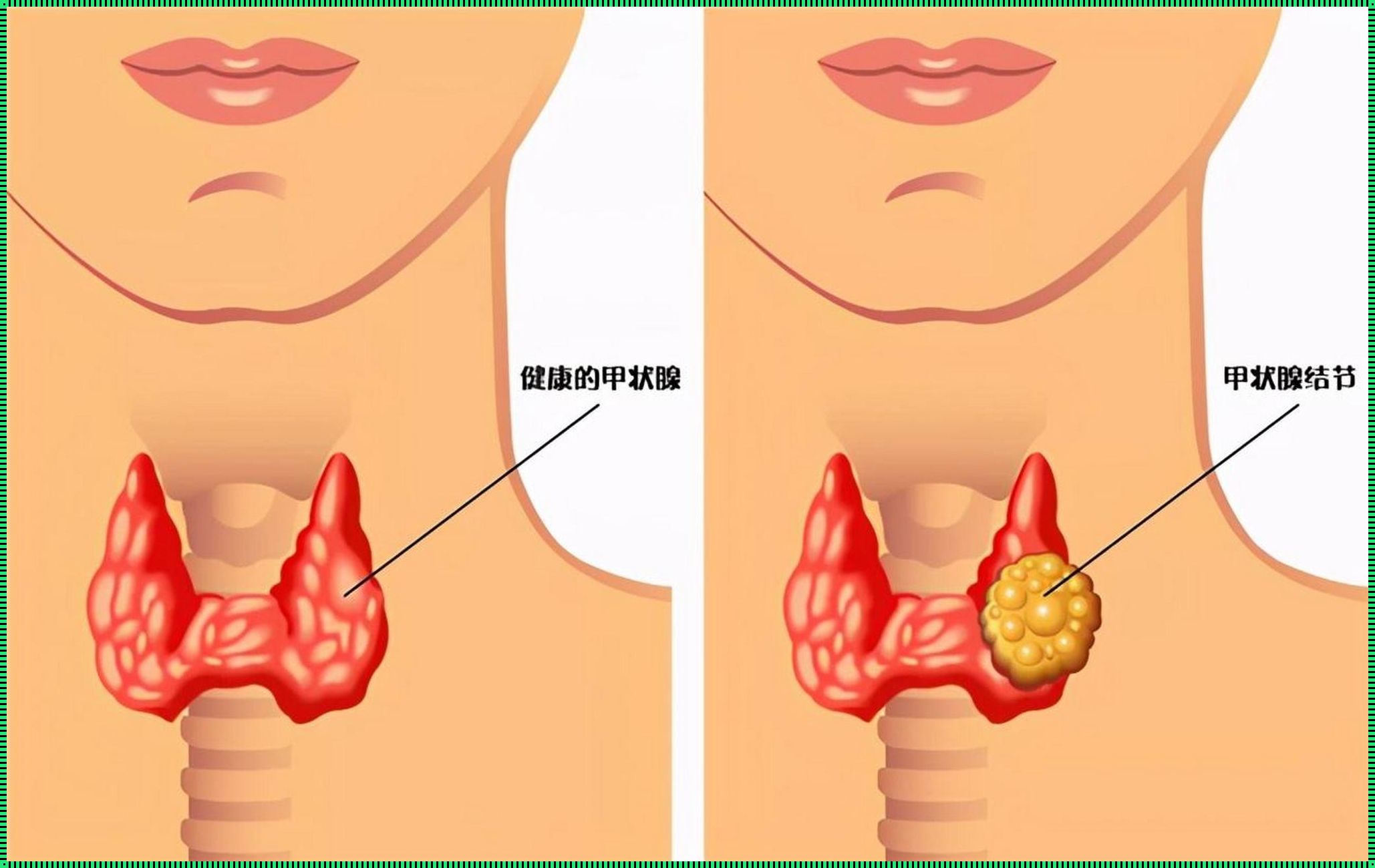 探索甲状腺炎的奥秘：疑难解答