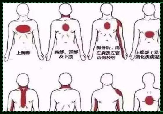 如何判断是不是心绞疼：深入解析令人震惊的症状