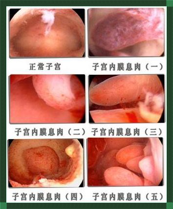 宫颈息肉会自己消失吗？揭开谜底，用仁心关爱女性健康