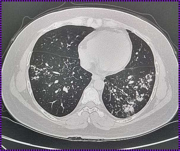 肺炎治疗中，CT复查的重要性