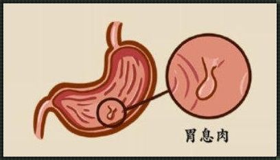 胃息肉五六年了没管他：健康隐患的惊现