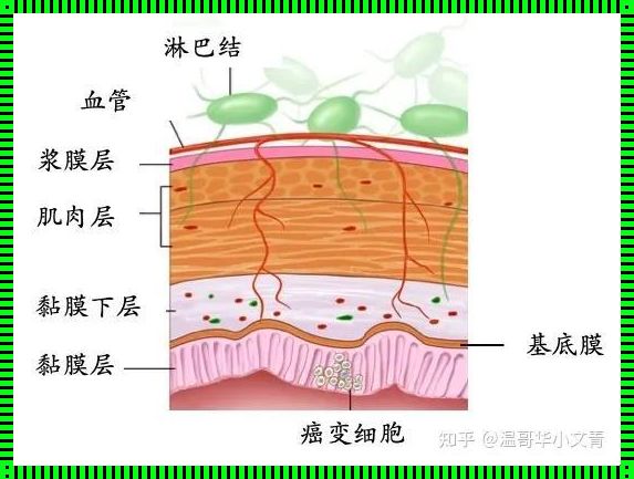 探寻原位癌的基底膜：分化中的秘密