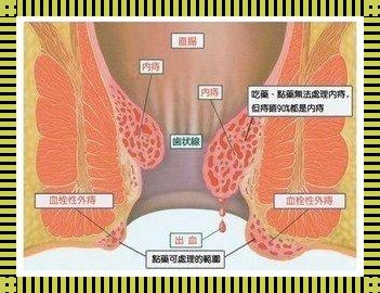 辣椒诱惑下的肛门之痛：解决火辣辣疼痛的方案