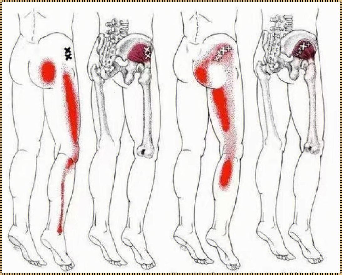 梨状肌综合症疼痛位置图：新品上市