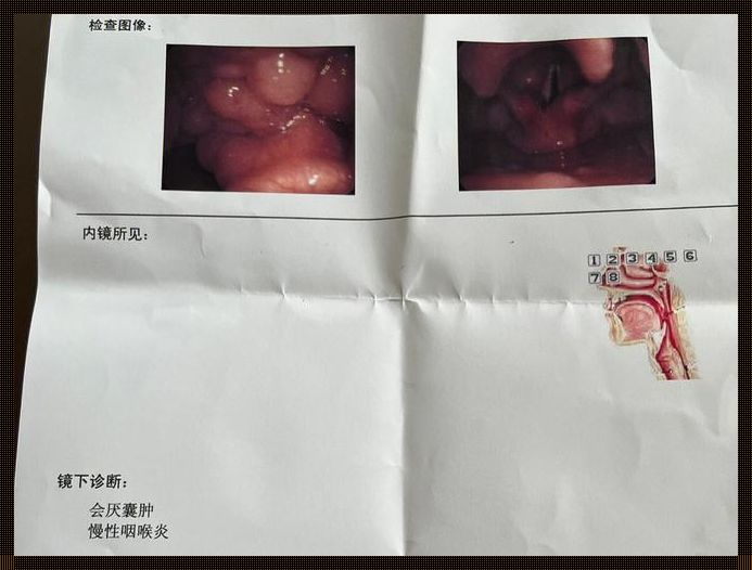 会厌囊肿手术要避开月经期吗？