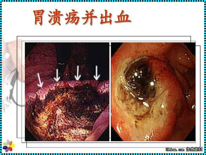 胃出血的五大症状：认识、预防和应对