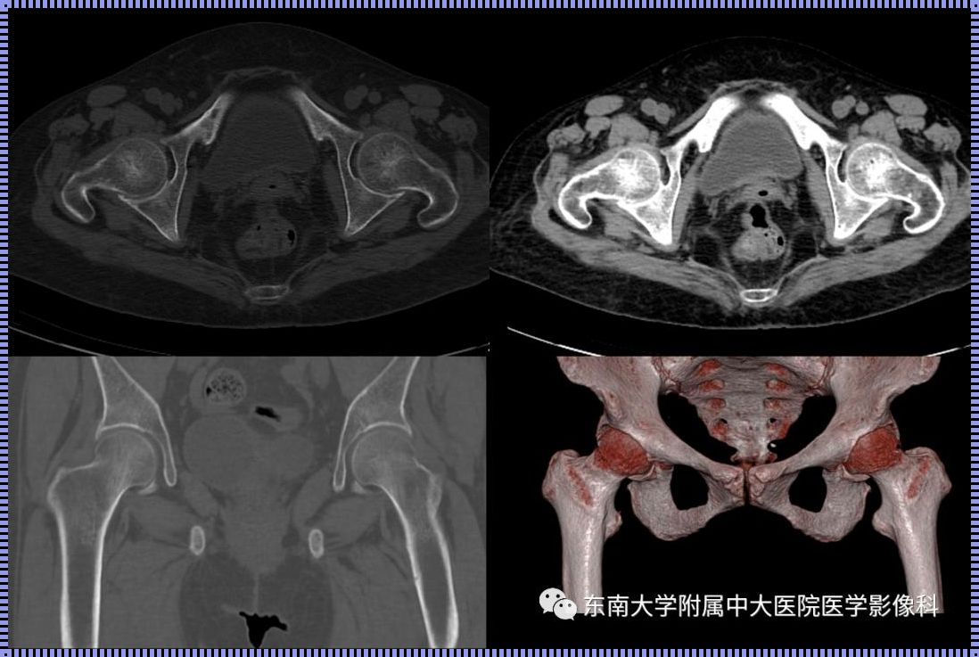 髋关节查核磁好还是CT好