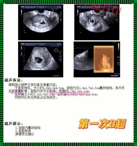 孕15周宫腔积液出血要排多久：的背后含义解析