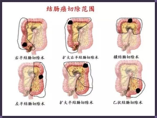 直肠癌4期可以降为3期吗？