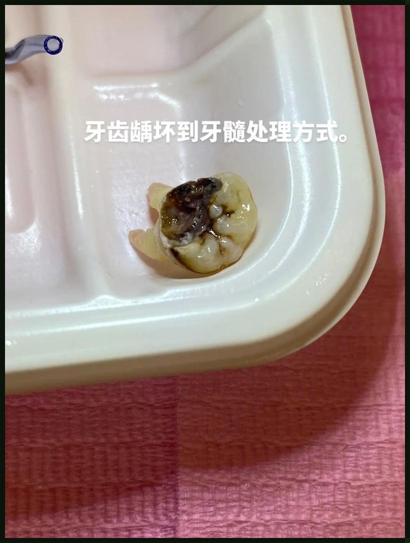 不想根管治疗有别的办法吗？