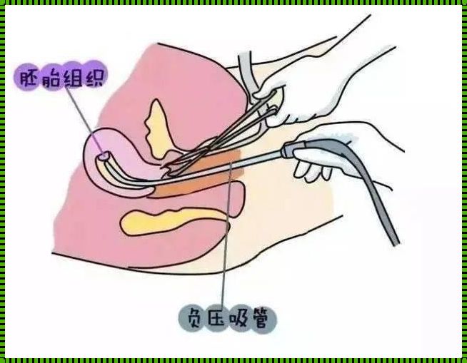 吸引产是剖腹产一种么：上海市的技艺