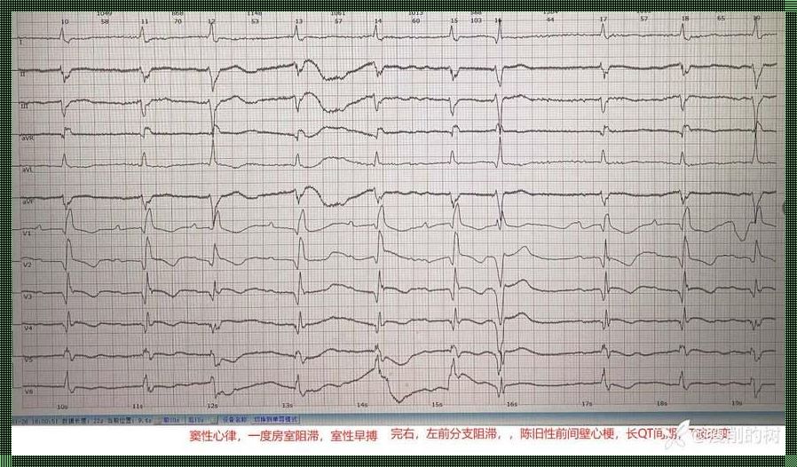 《窦性心律与T波改变：探寻生命节奏的奥秘》