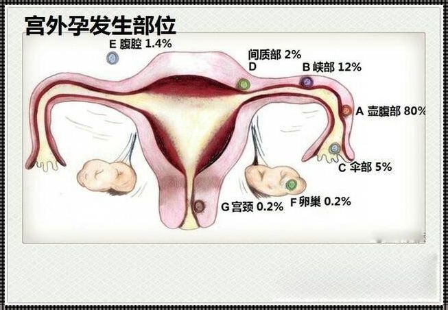 宫外孕：命运的偏离与生命的顽强