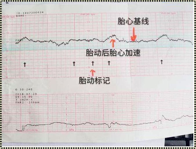 胎心监测：生命律动的奥秘与解读