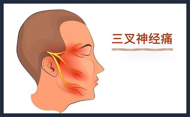 三叉神经痛：自愈的奇迹与科学的边界