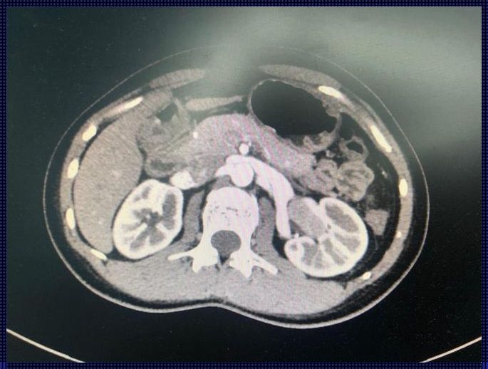 肾腺瘤1.5—2.4厘米：手术与生命的抉择