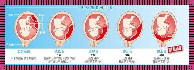 胎盘离宫颈内口的安全距离：生命之门的守护者