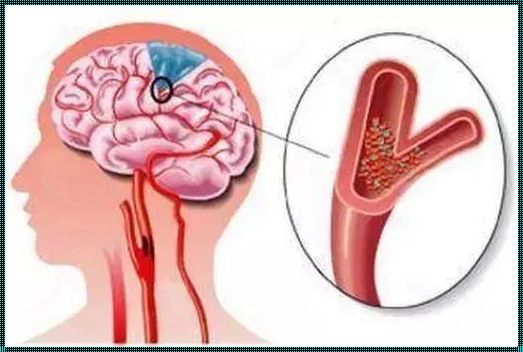 颈椎动脉狭窄：生命之脉的隐秘危机