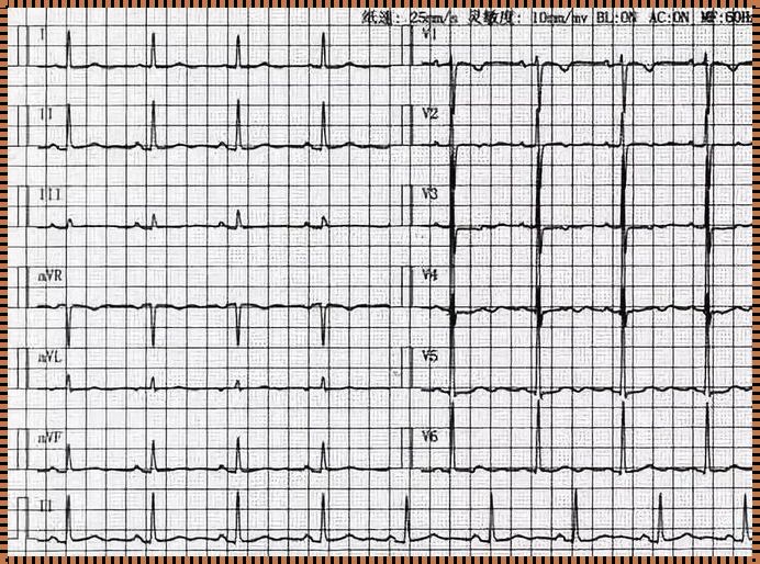 体检之谜：女性T波低平，原因为何?