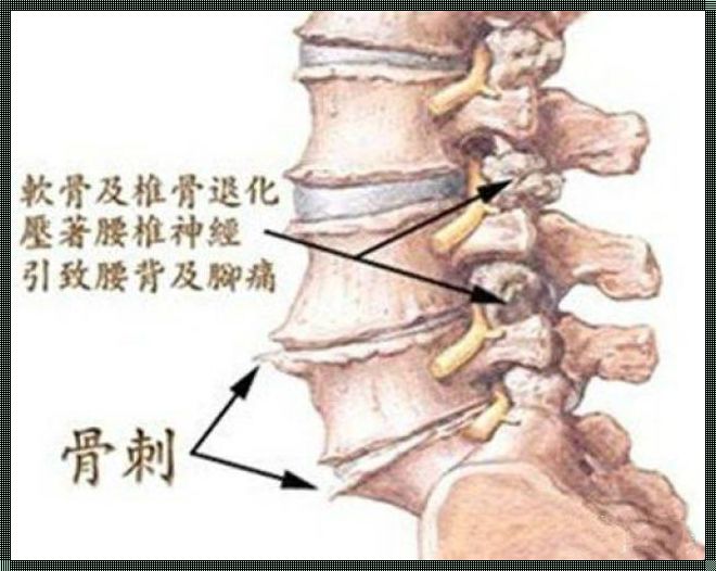 钙的奥秘：骨刺是缺钙的误解还是钙过量的困境？