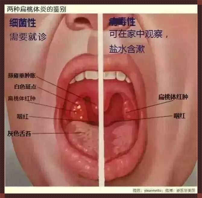 口腔炎辨识攻略：轻松get健康密码