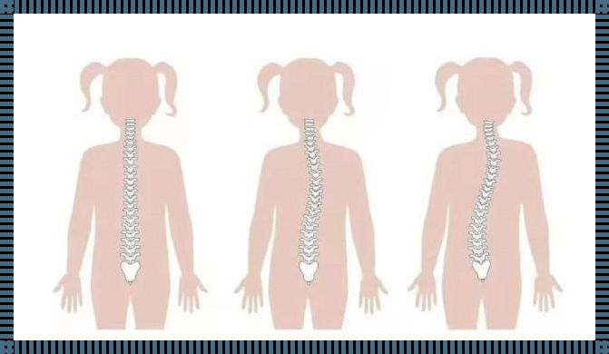 探索脊柱侧弯C与S：哪种状况更为严重？