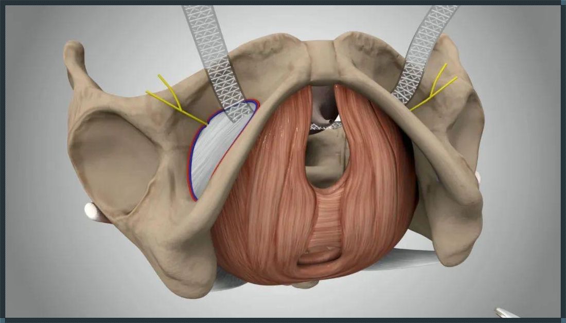 尿道悬吊术后，意外触碰是否导致断裂？探秘使用心得与健康奥秘