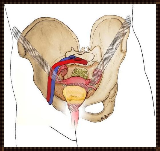 尿道悬吊术后，意外触碰是否导致断裂？探秘使用心得与健康奥秘